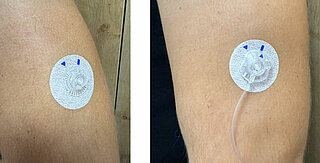 Patient avec système de pompe Siatlab